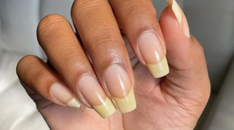 Understanding Yellowing Spots on Nails: Causes, Treatment, and Prevention